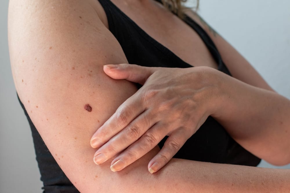 Menschen mit vielen Pigmentmalen sind besonders gefährdet.