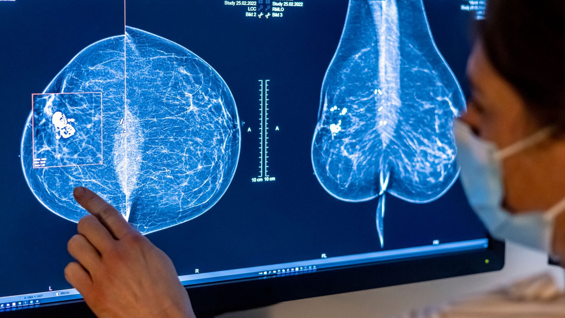 Für Frauen gibt es eine spezielle Untersuchung, um Krebs früh zu entdecken: die Mammografie. (Archivbild)