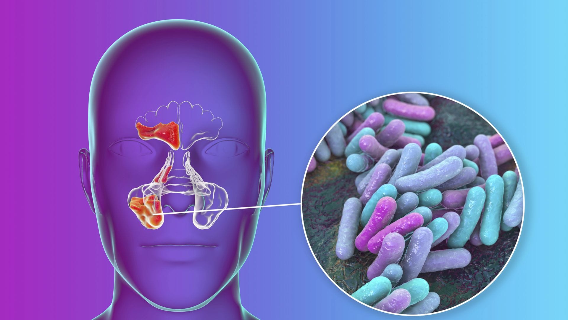 HIB steht für Haemophilus influenzae Typ b, ein Bakterium, das schwere Infektionen, insbesondere bei Kindern, verursachen kann. Zu den möglichen Erkrankungen gehören bakterielle Hirnhautentzündung (Meningitis) und Kehldeckelentzündung (Epiglottitis).